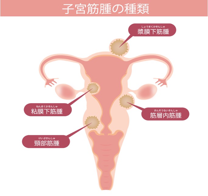子宮筋腫の種類