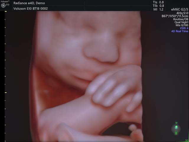 GE社Voluson E10について